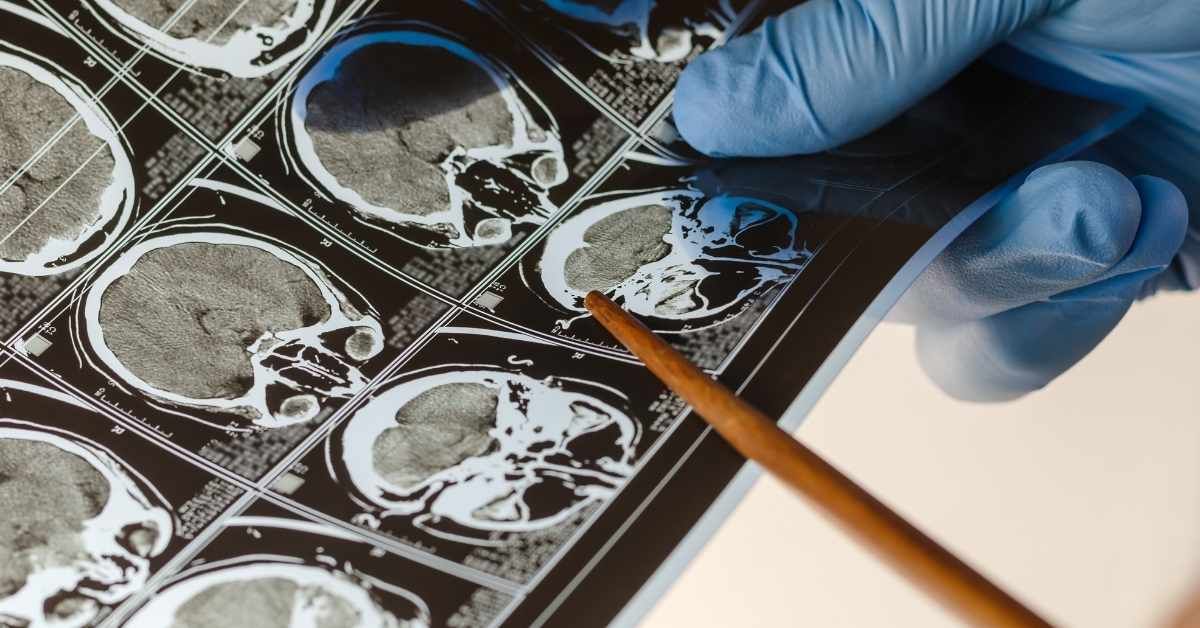 Aneurisma sintomi premonitori