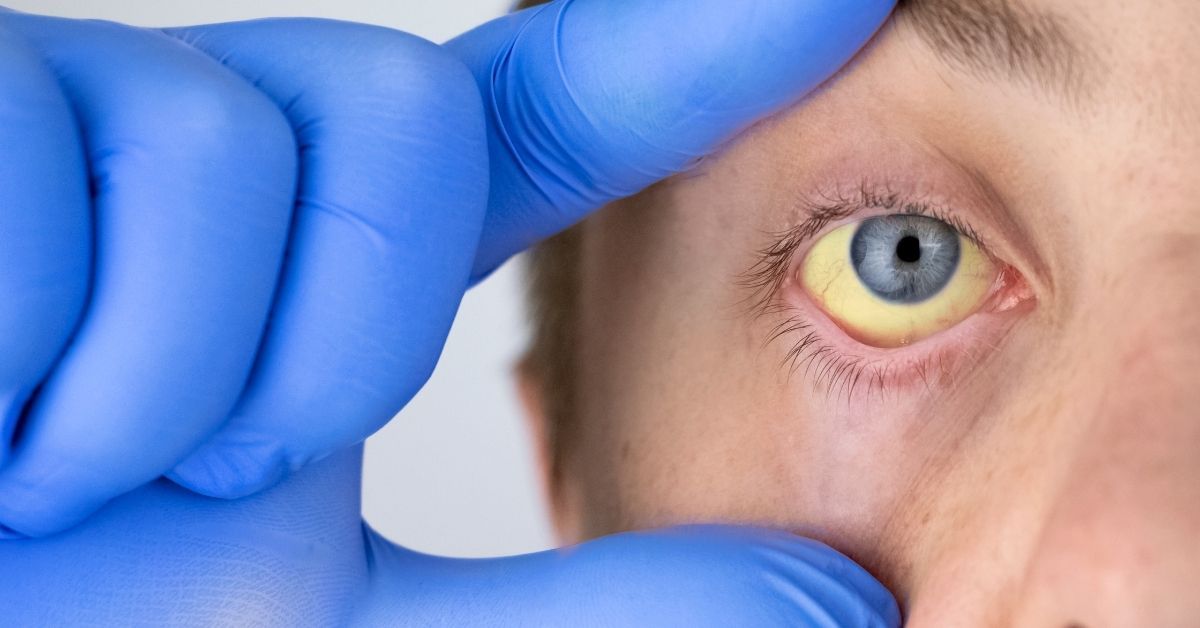 Sintomi della colangite