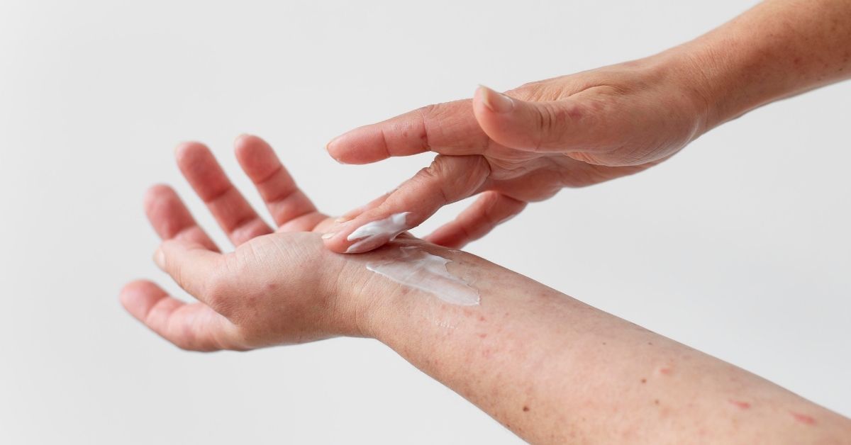 Eczema nummulare: cura e rimedi