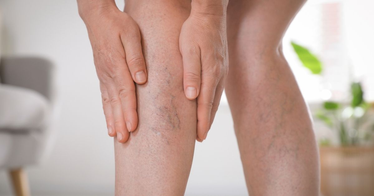 Flebite: quando preoccuparsi