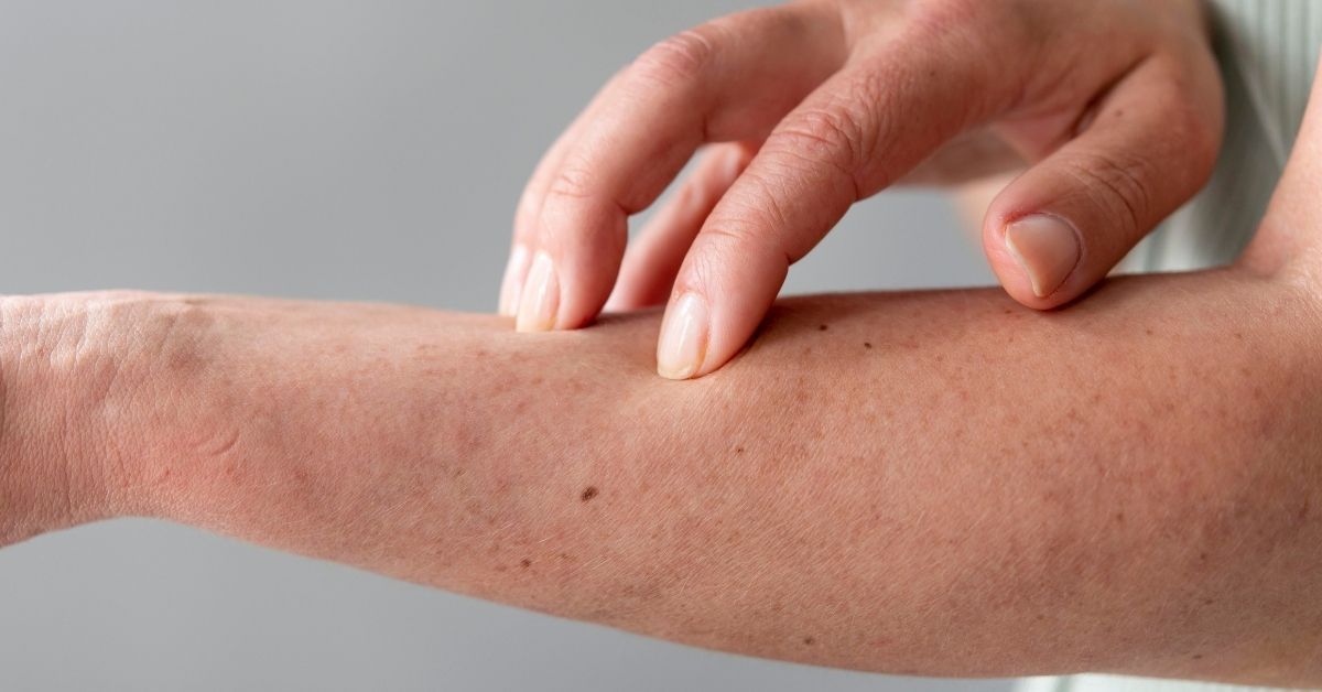 Intolleranza all'istamina sintomi