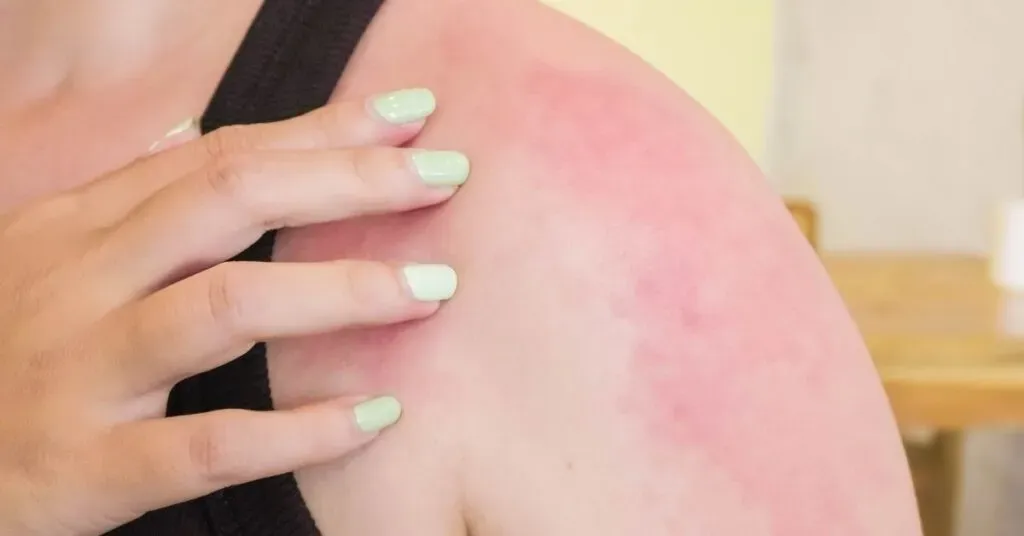 allergie crociate