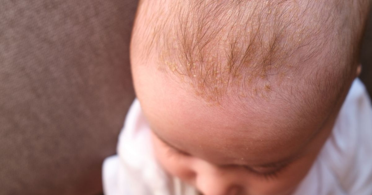 dermatite seborroica neonato