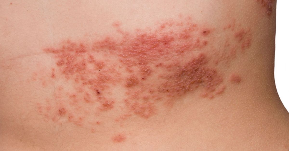 fuoco di sant'antonio