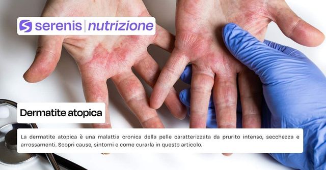 Dermatite atopica mani