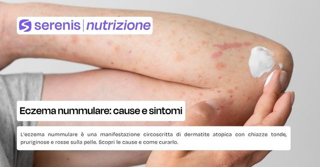 Eczema nummulare
