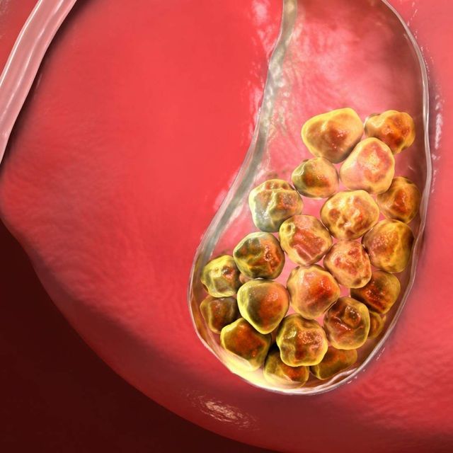 calcoli-billari-cosa-mangiare.jpg