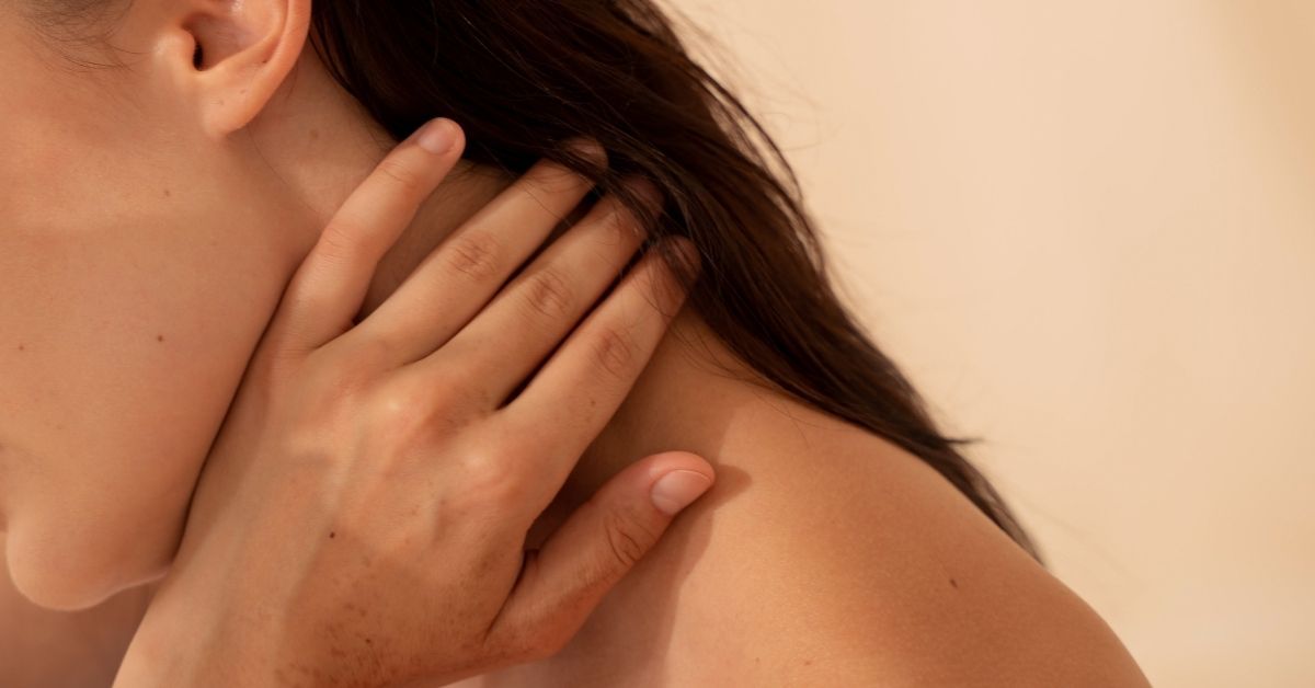 rosacea