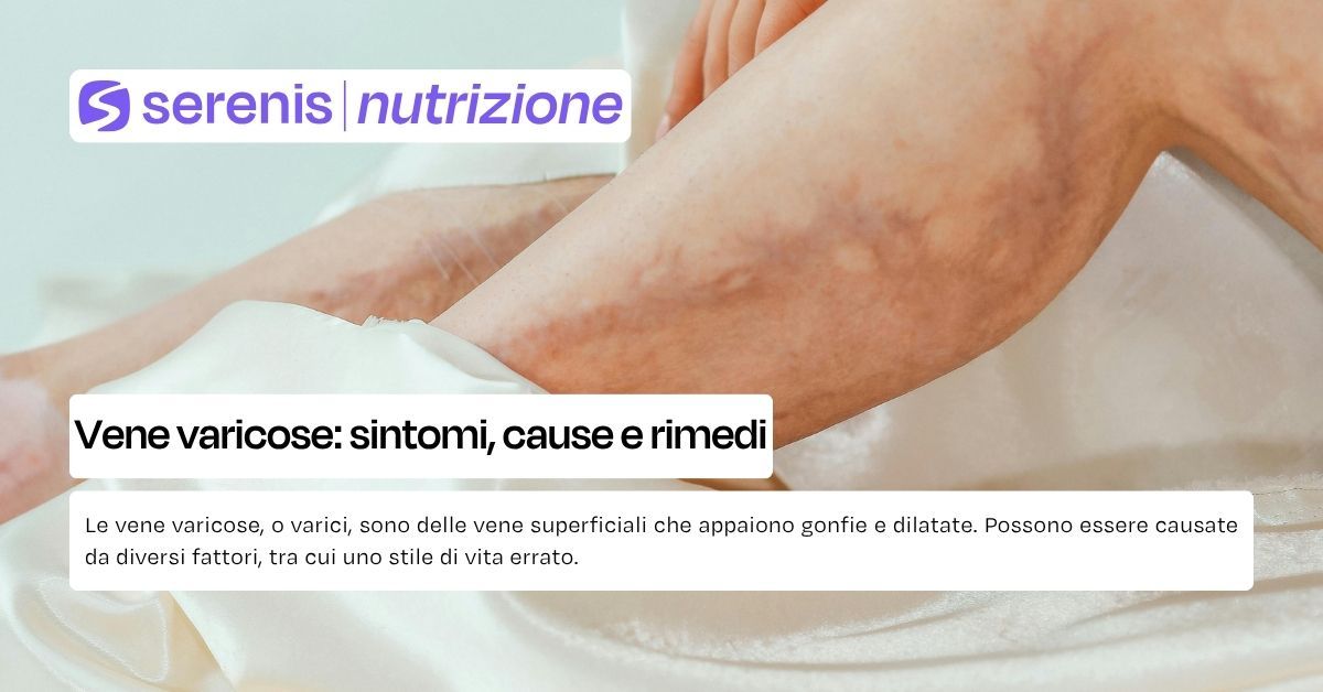 vene varicose