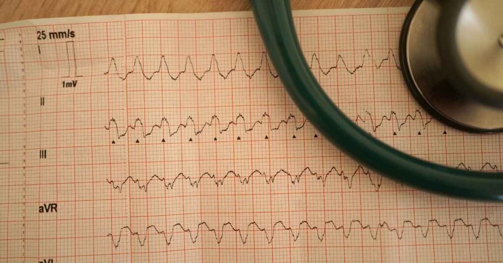 Elettrocardiogramma per tachicardia