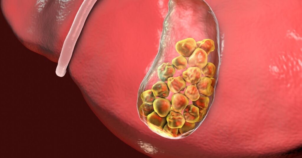 Calcoli alla cistifellea